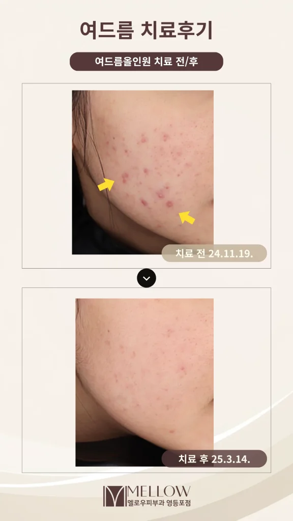 턱선·볼 농포성 여드름 8회 치료 후기