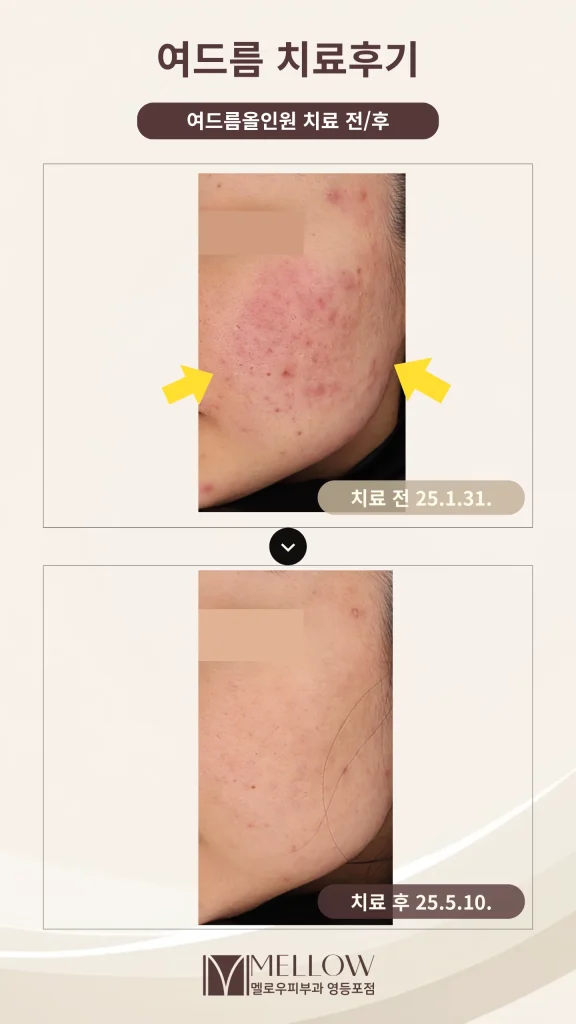 20대 여성 여드름 치료 후기 #염증성 여드름 #여드름 흉터
