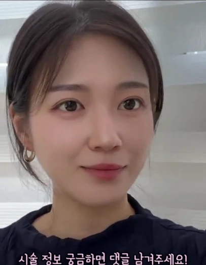 시술 후 백합님 클로즈업