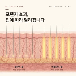 포텐자 레이저 효과, 팁별로 알아보기 - 절연·비절연·싱글니들·펌핑·비침습 팁은 무엇이 다를까