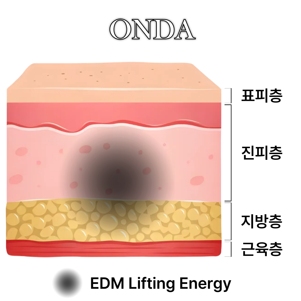 온다리프팅