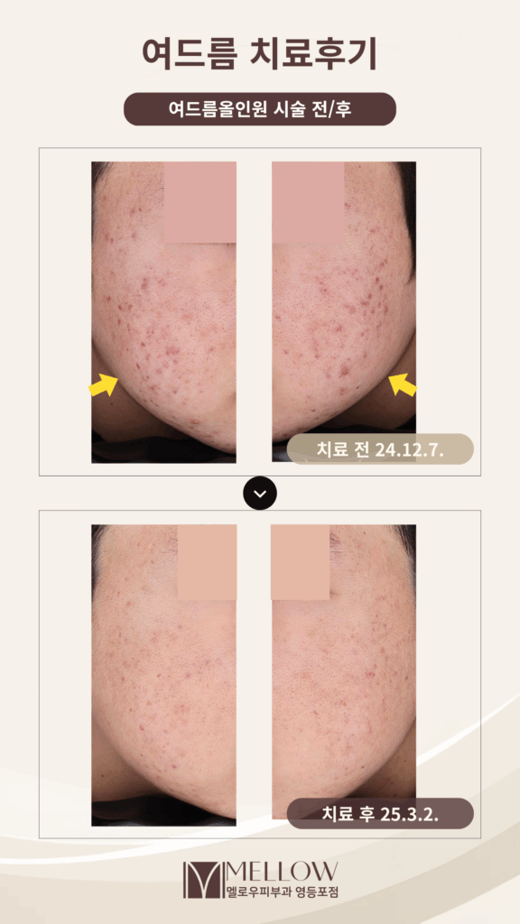 여드름치료후기