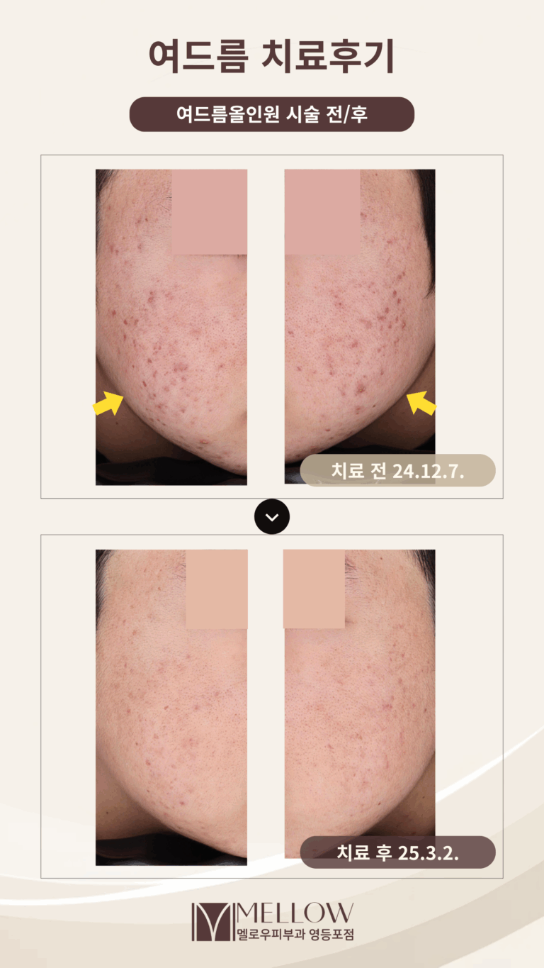 20대 남성 염증성 여드름 치료 후기