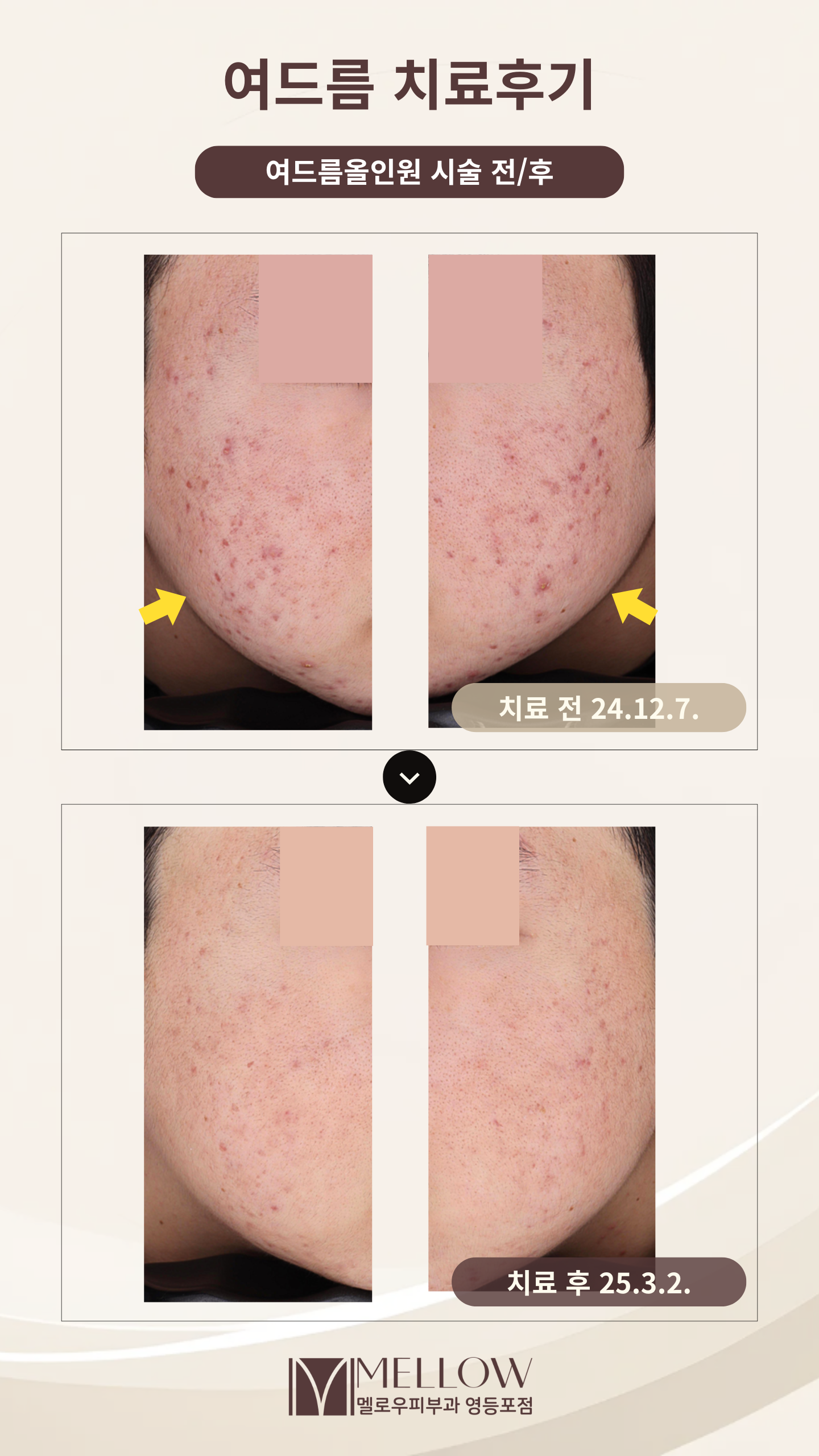 여드름치료후기