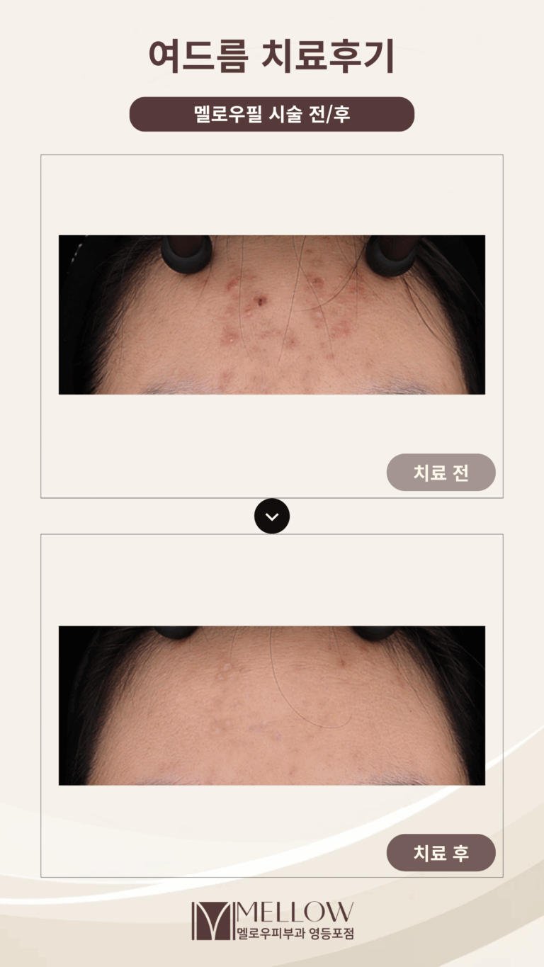 10대의 이마 염증성여드름, 치료 후 변화는?