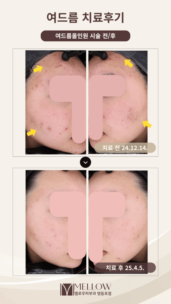 여드름 치료 후기