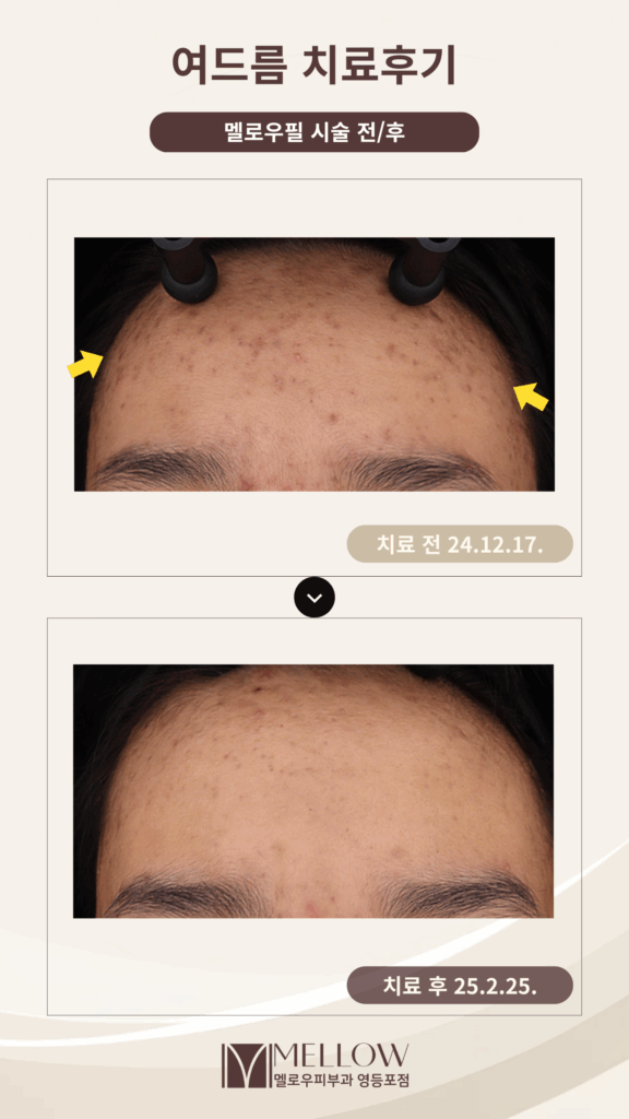 여드름, 스케일링 후기