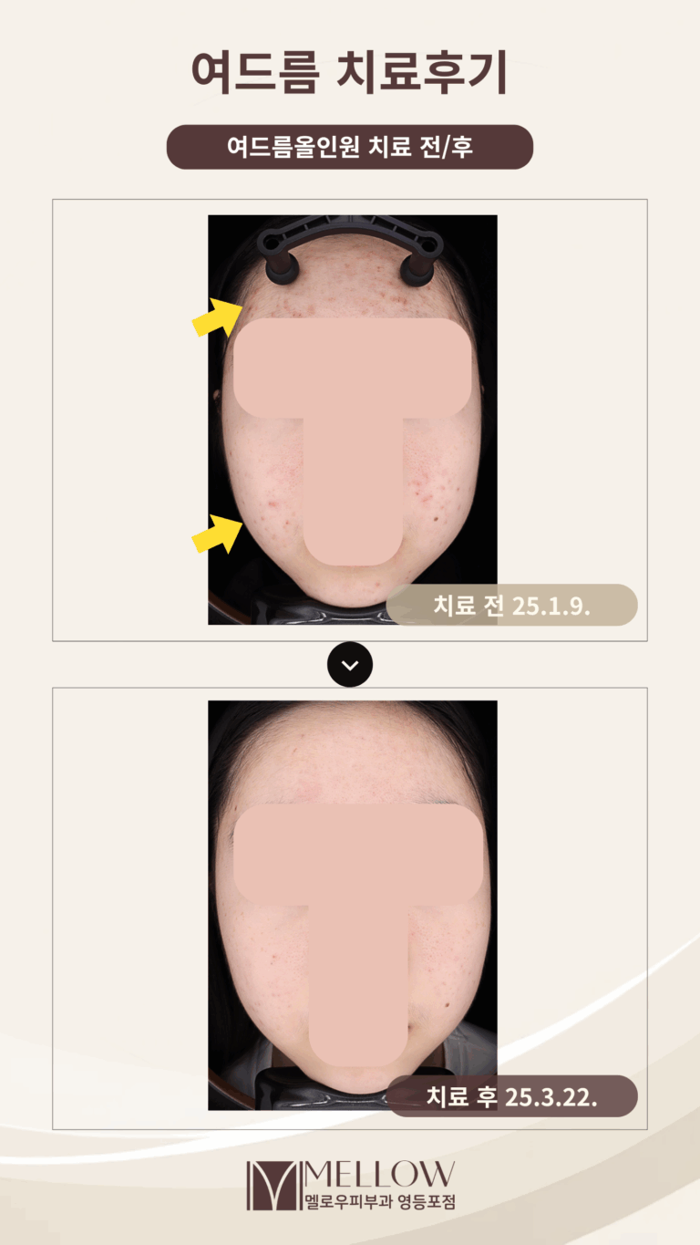 10대 여성 환자 염증성여드름 극복 후기