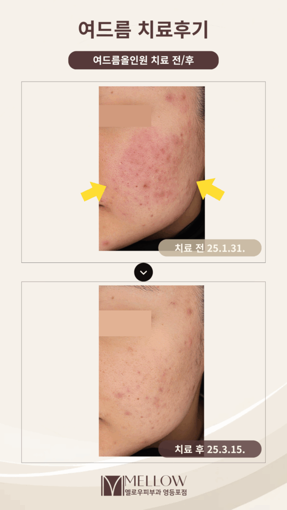 20대 여성 여드름 치료 후기