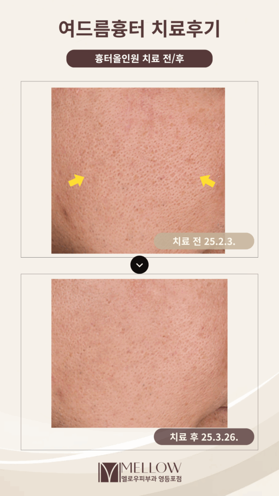 흉터올인원