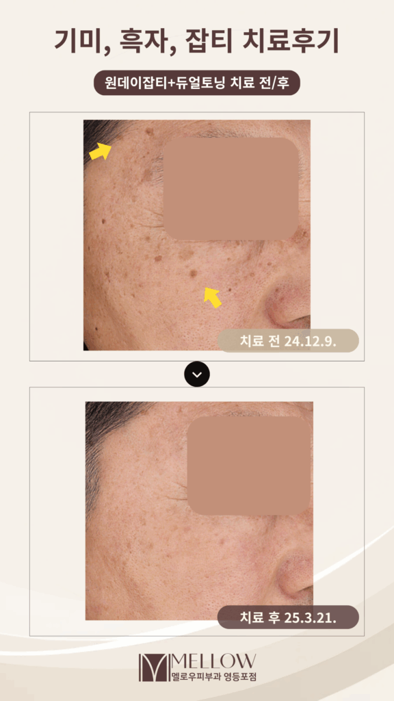 60대 남성 흑자, 기미 치료 후기