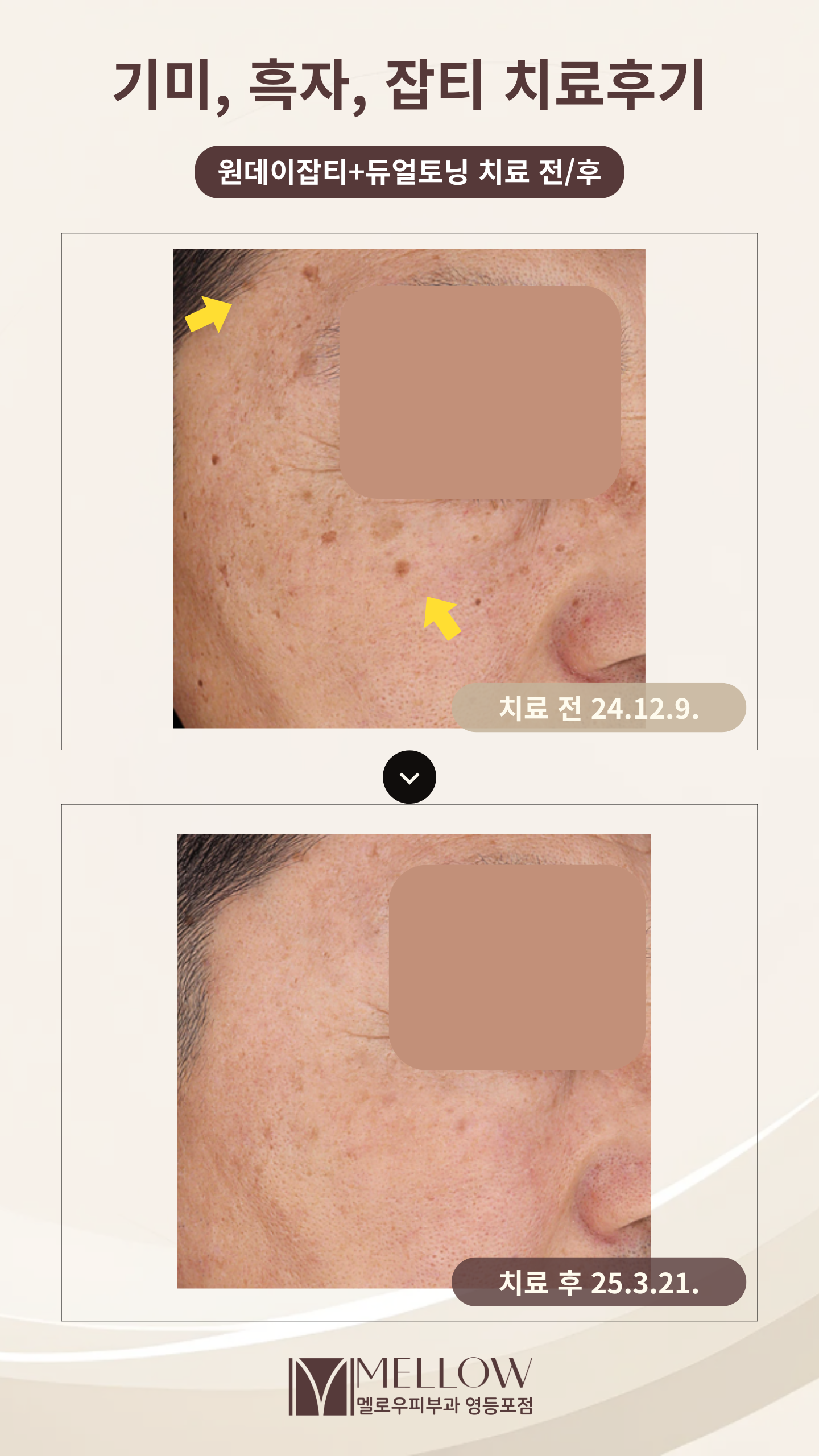 60대 남성 흑자, 기미 치료 후기