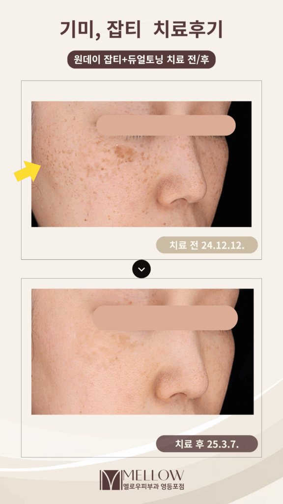기미 잡티 치료 후기