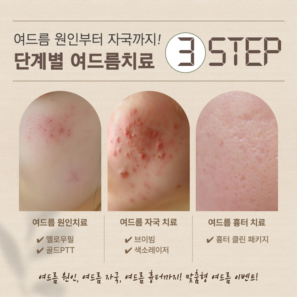 멜로우피부과 여드름 이벤트