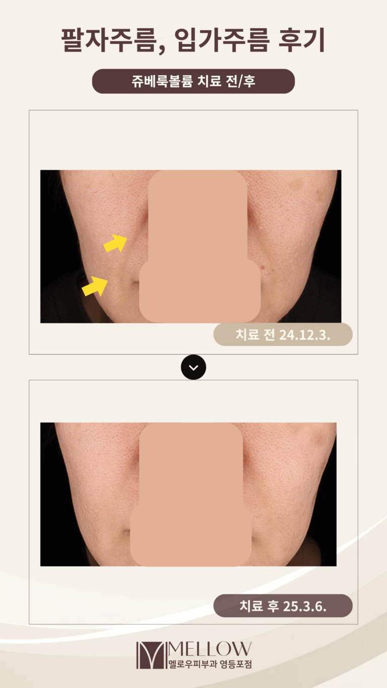 50대 여성 팔자주름, 입가주름 개선 후기 #쥬베룩 볼륨