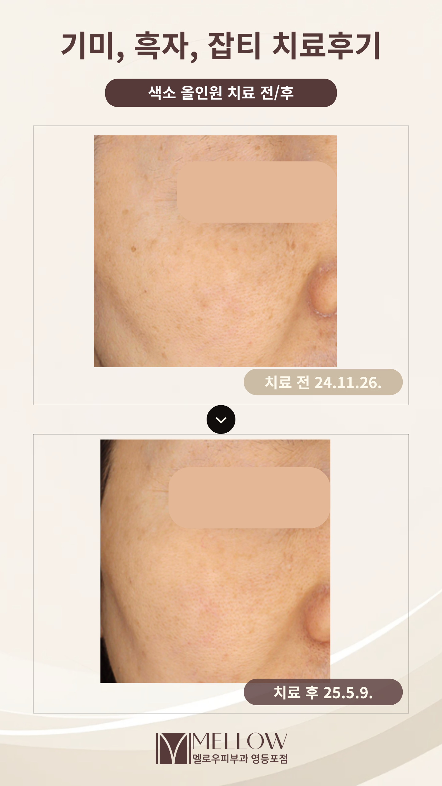 기미 잡티