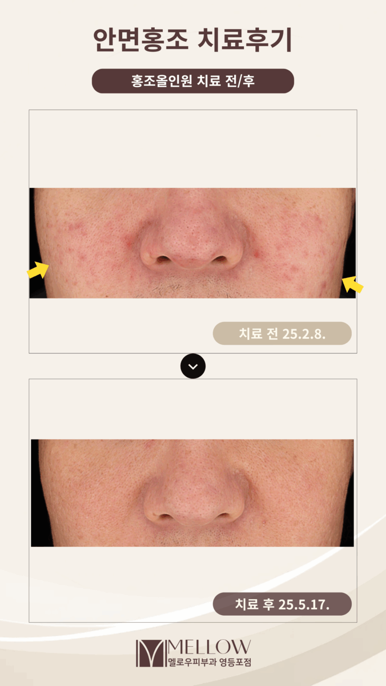 50대 남성 안면홍조 피부과 치료 후기 #홍조올인원