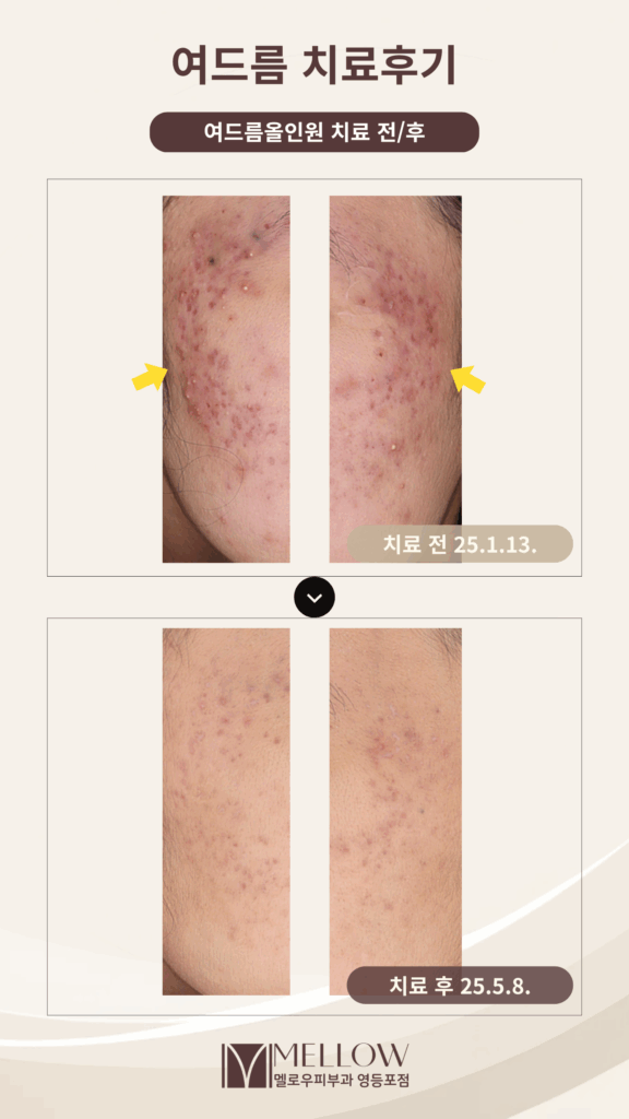 10대 여드름