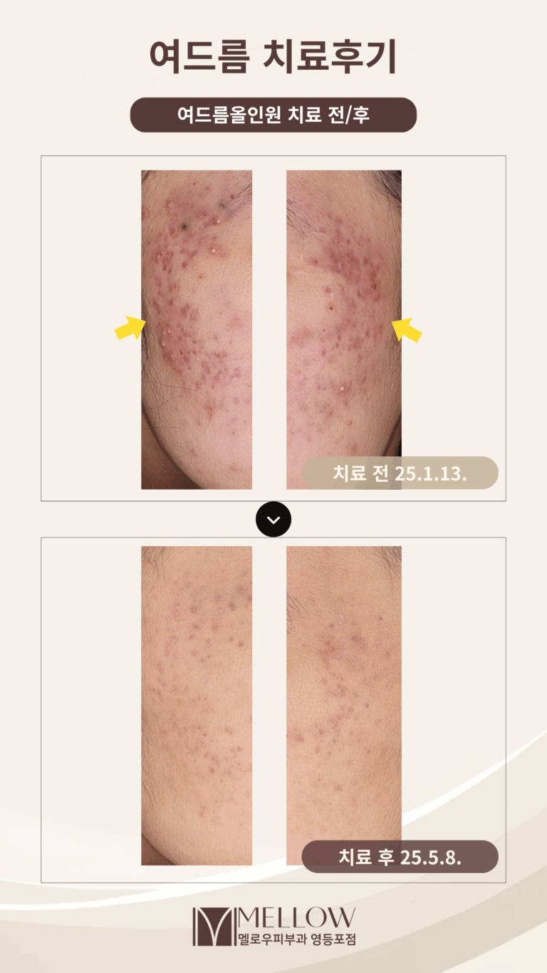 10대 여드름 치료 후기 #여드름올인원