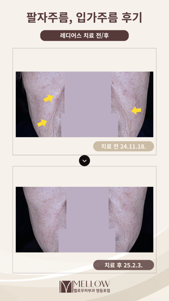 팔자, 입가주름