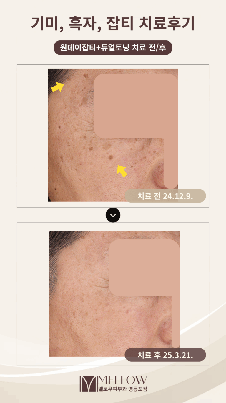 60대 남성 흑자, 기미, 잡티 레이저 치료 후기