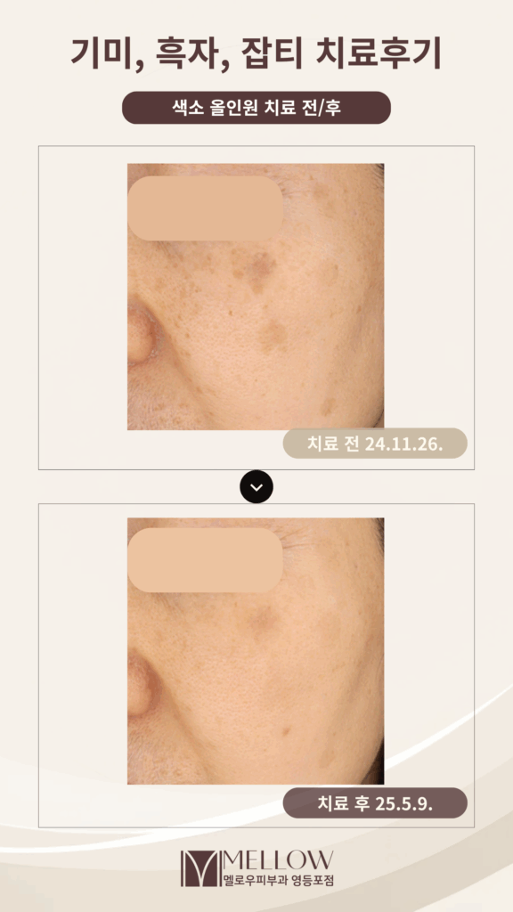 50대 기미, 잡티, 흑자