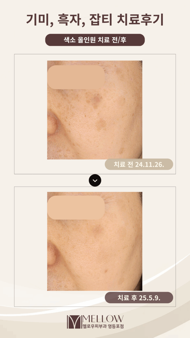50대 여성 기미, 흑자, 잡티 혼재 치료 후기 #색소올인원
