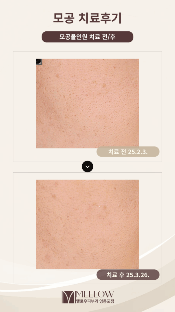 모공치료