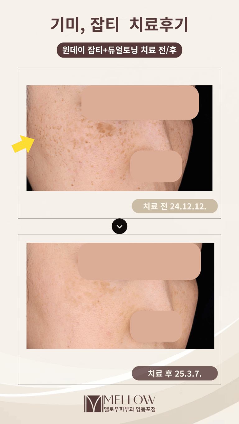 40대 여성 기미, 잡티 레이저토닝 치료 후기