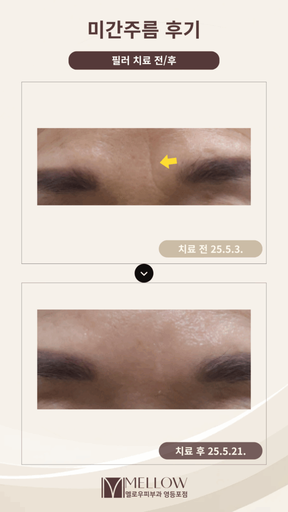 미간주름 필러 시술