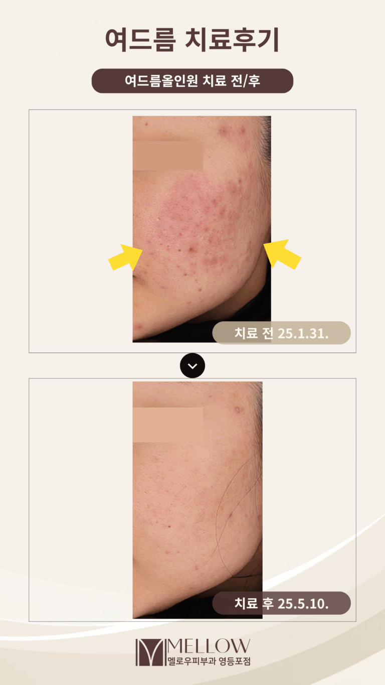 20대 여성 여드름 치료 후기 #염증성 여드름 #여드름 흉터