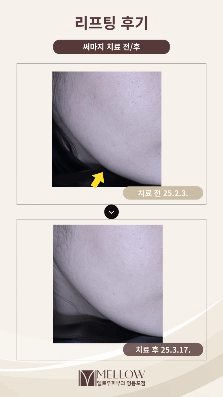 30대 여성  써마지 리프팅 상담 후기