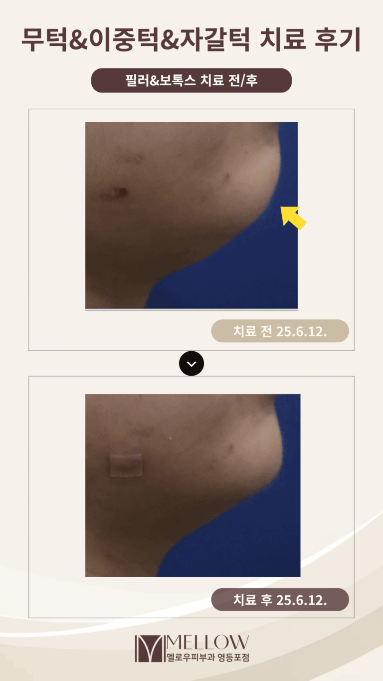 20대 여성  무턱, 이중턱 필러 시술 후기
