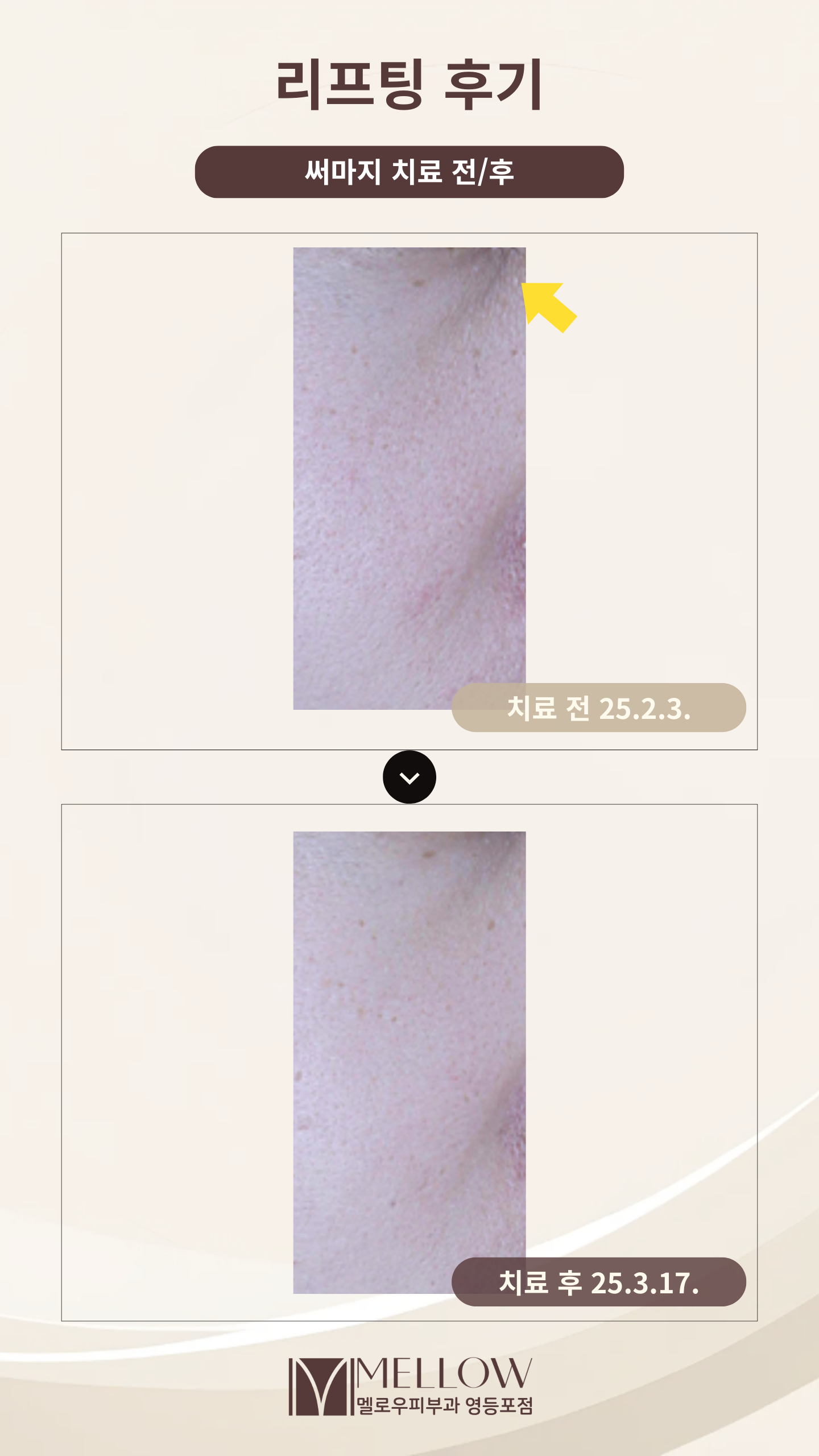 써마지 리프팅