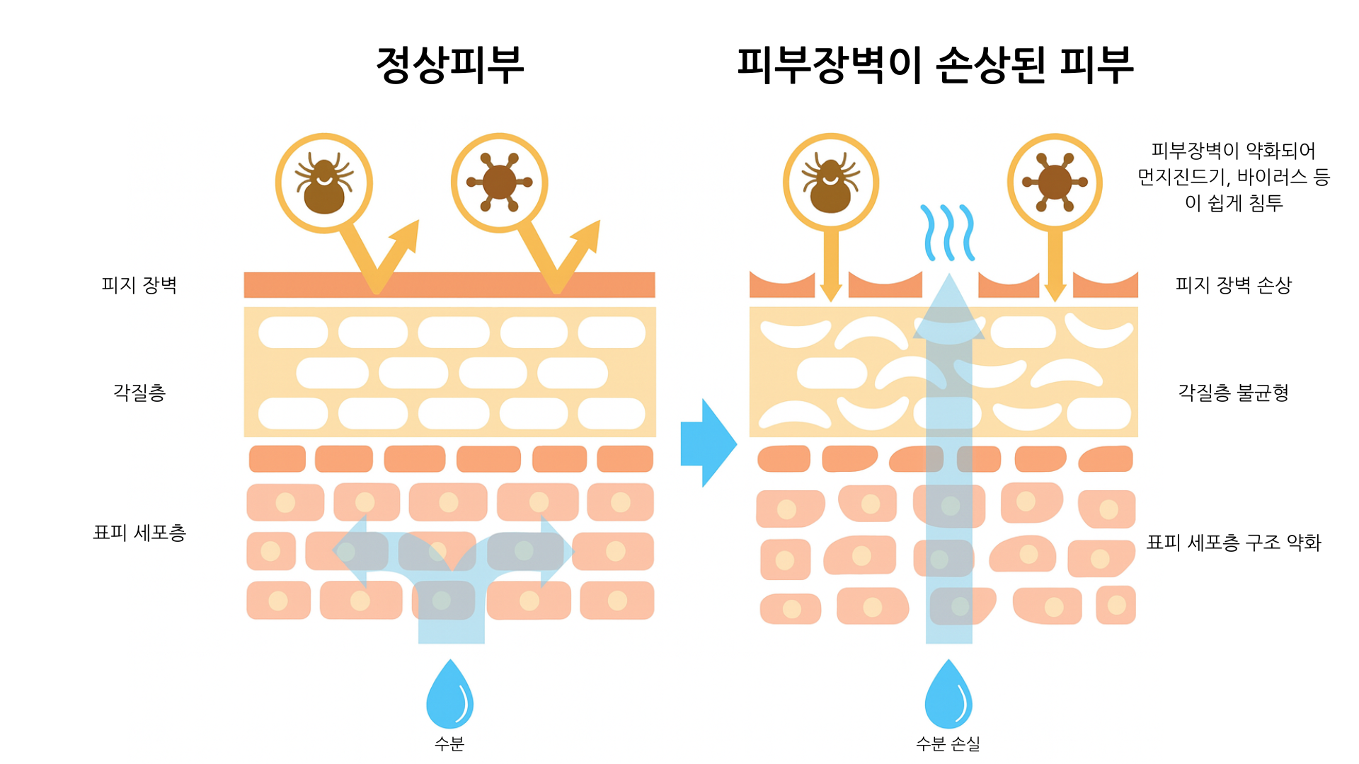 피부 장벽 손상과 혈관 민감화