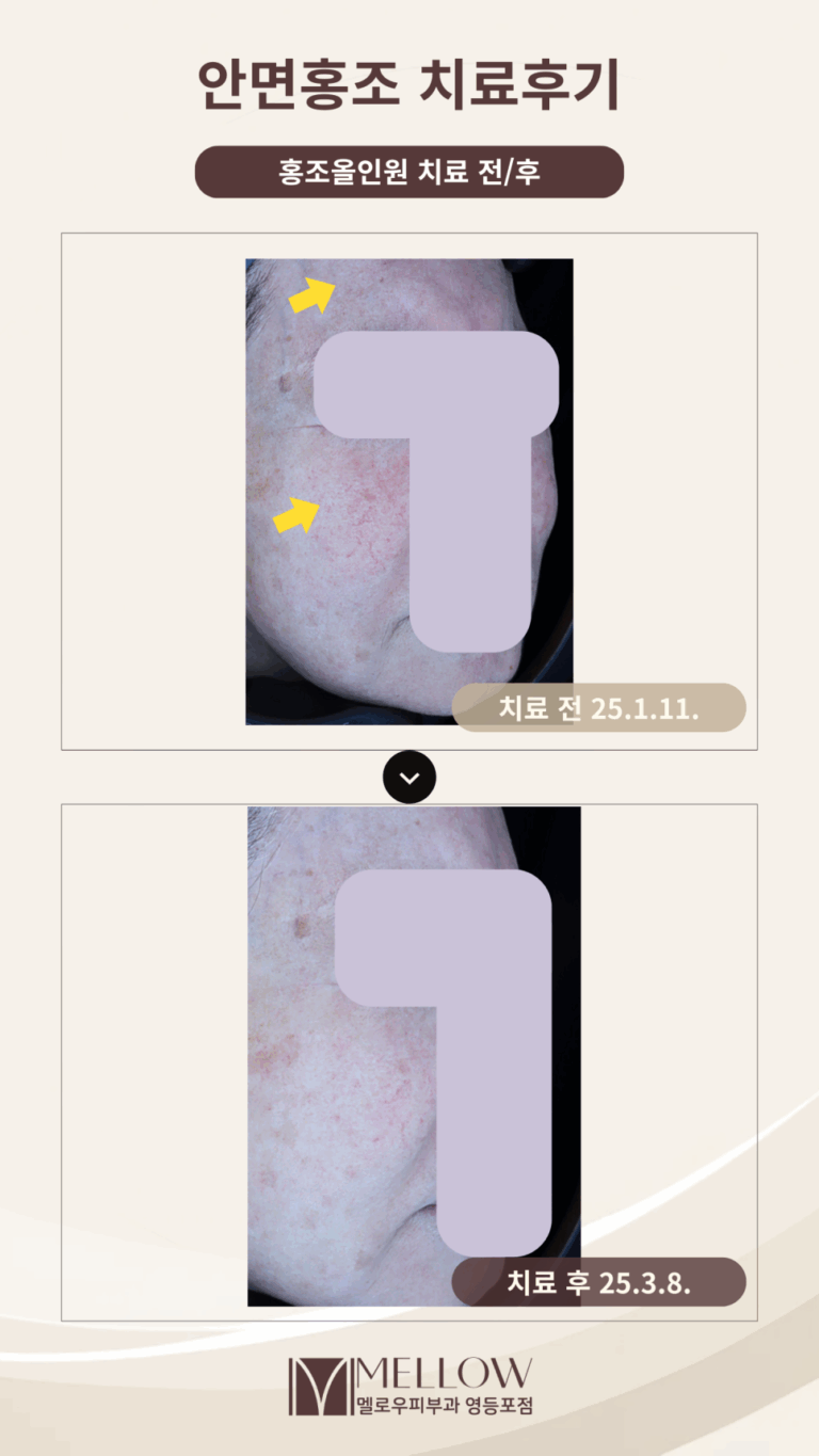 60대 여성 안면홍조, 핏줄비침 치료 후기 #클라리티