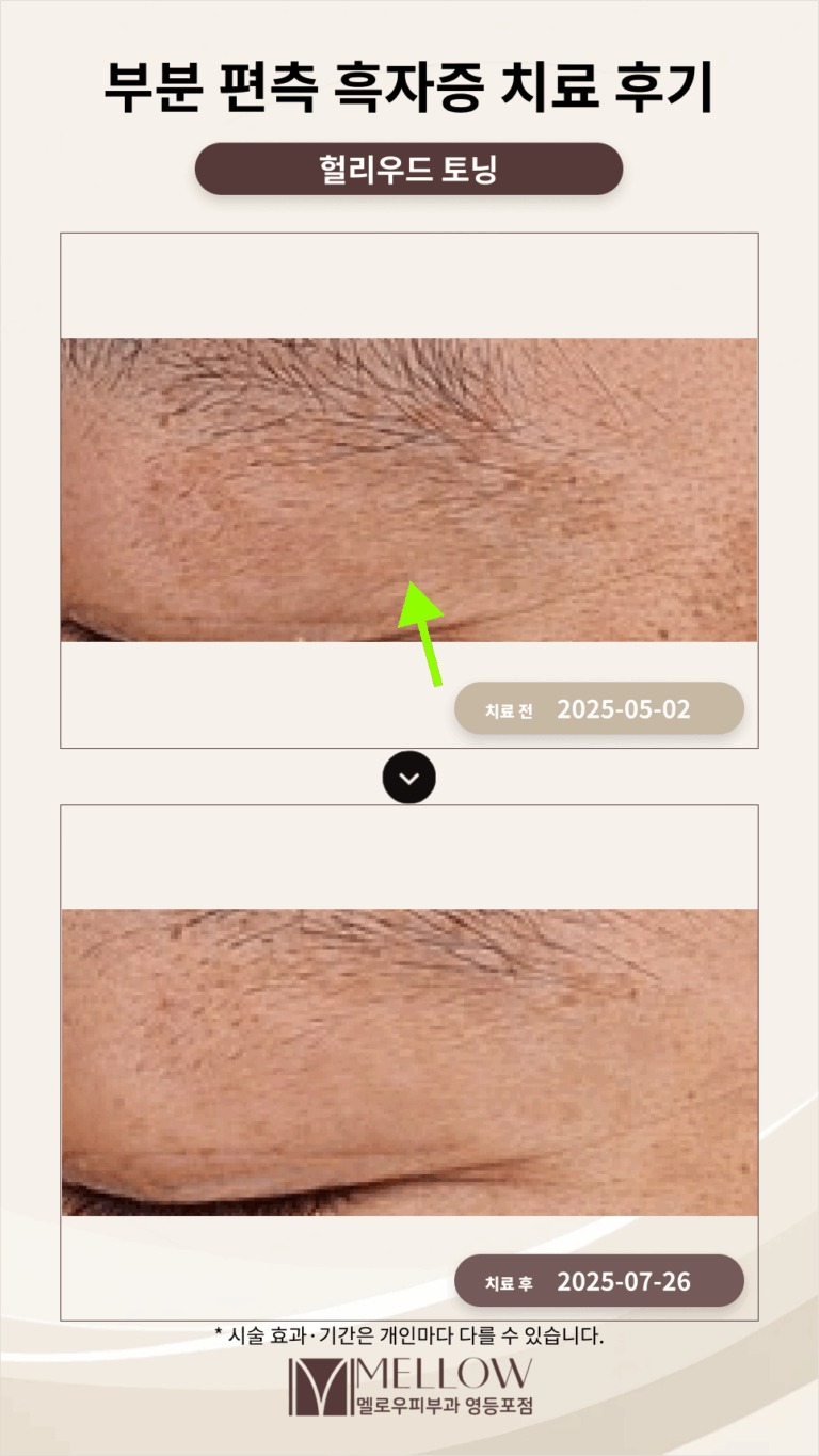 50대 남성 광대 주변 부분편측흑자증 치료 후기