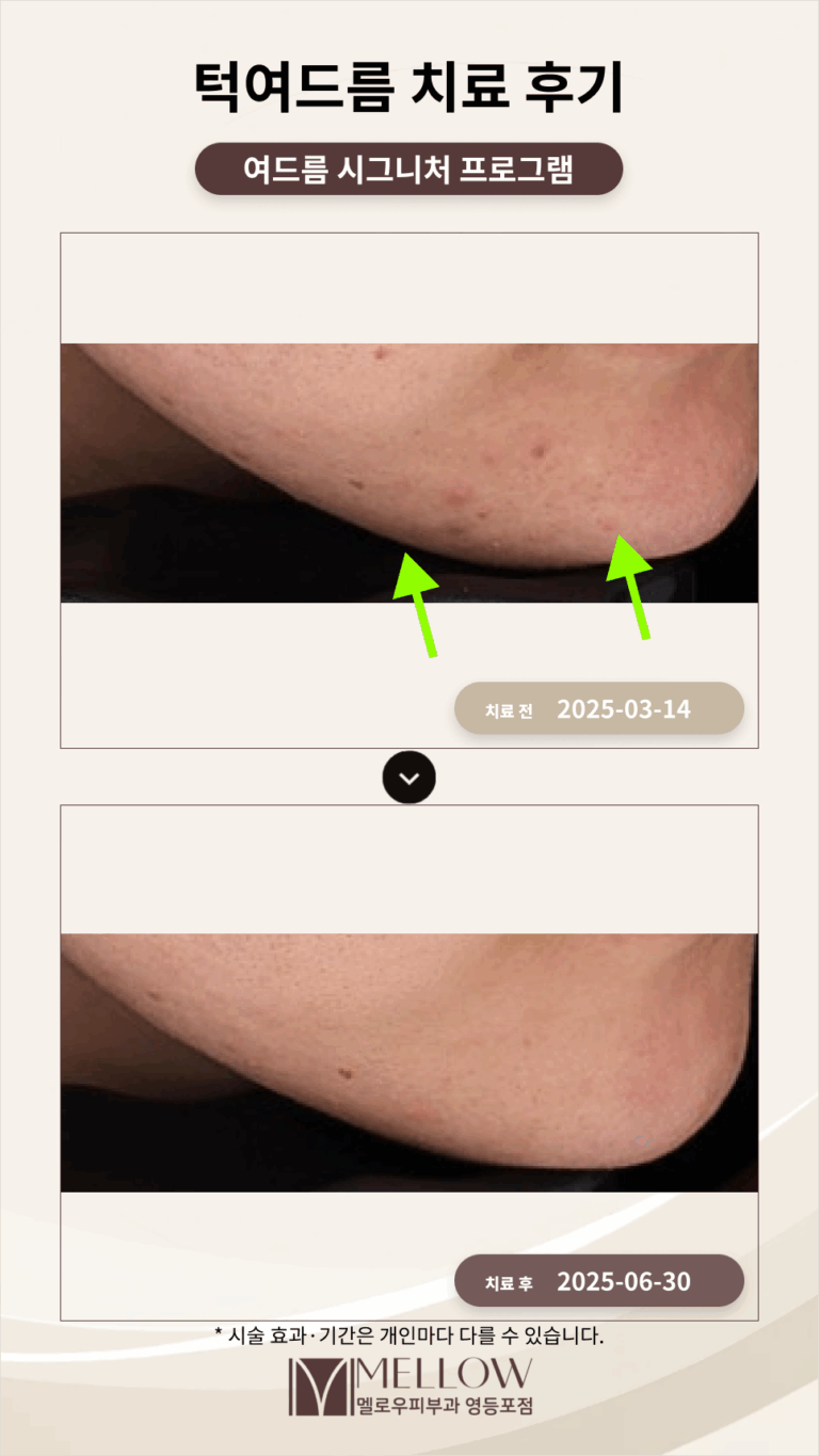 여성 턱여드름 자국 치료 후기 #생리주기여드름