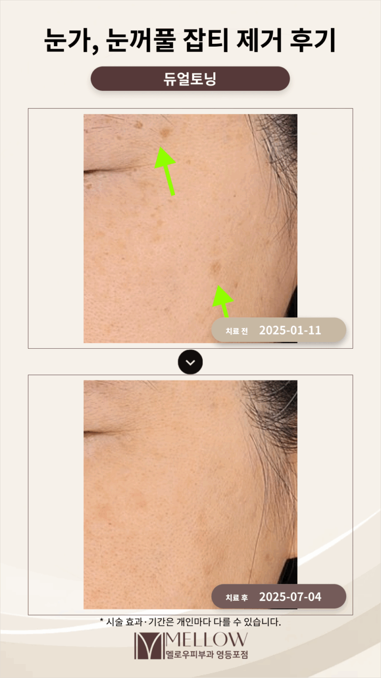 40대 여성 눈가, 눈꺼풀 잡티 제거 후기_여의도 피부과 전문의