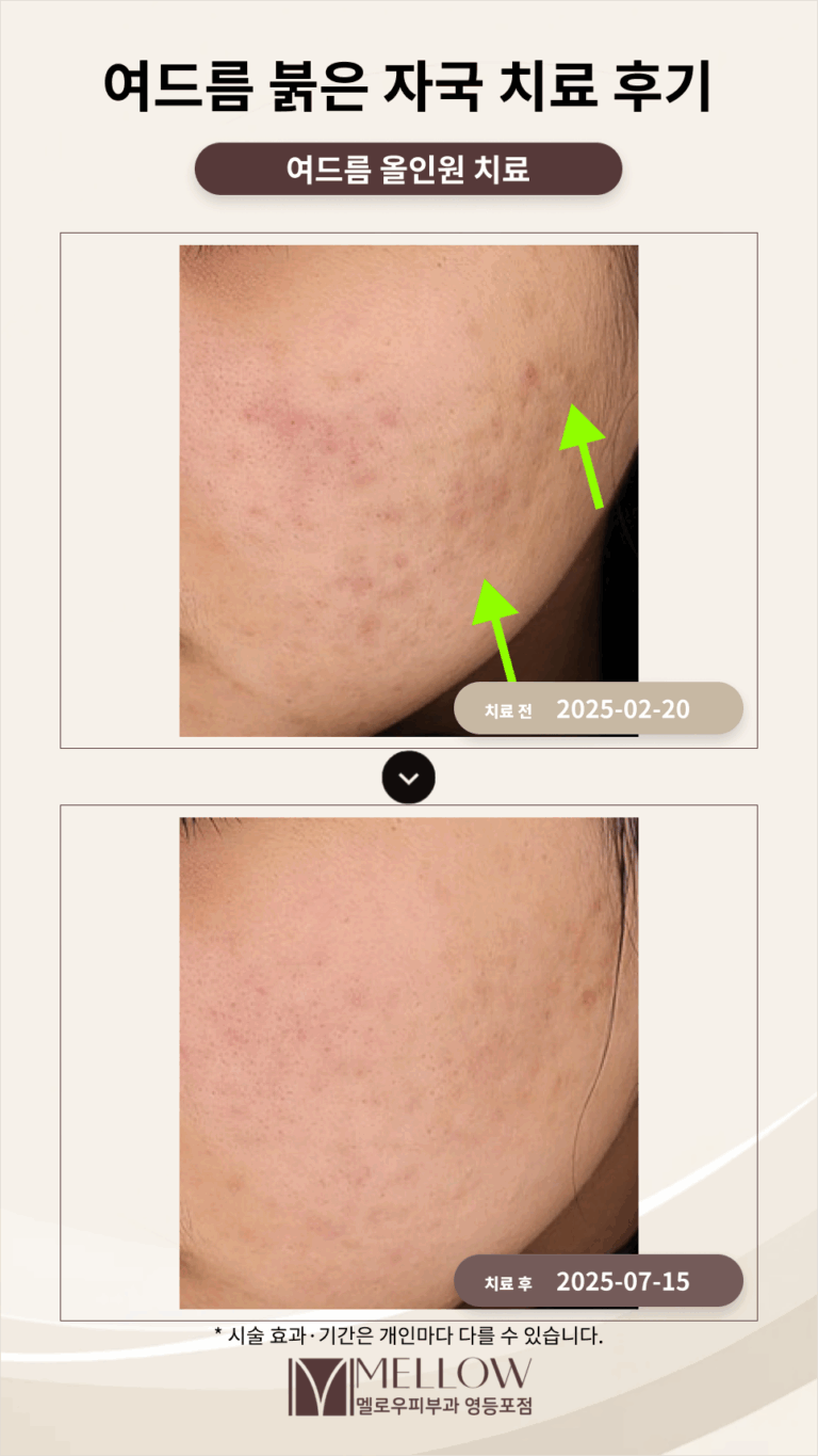 20대 여드름 색소 침착, 붉은 자국 치료 후기_여의도 피부과 전문의