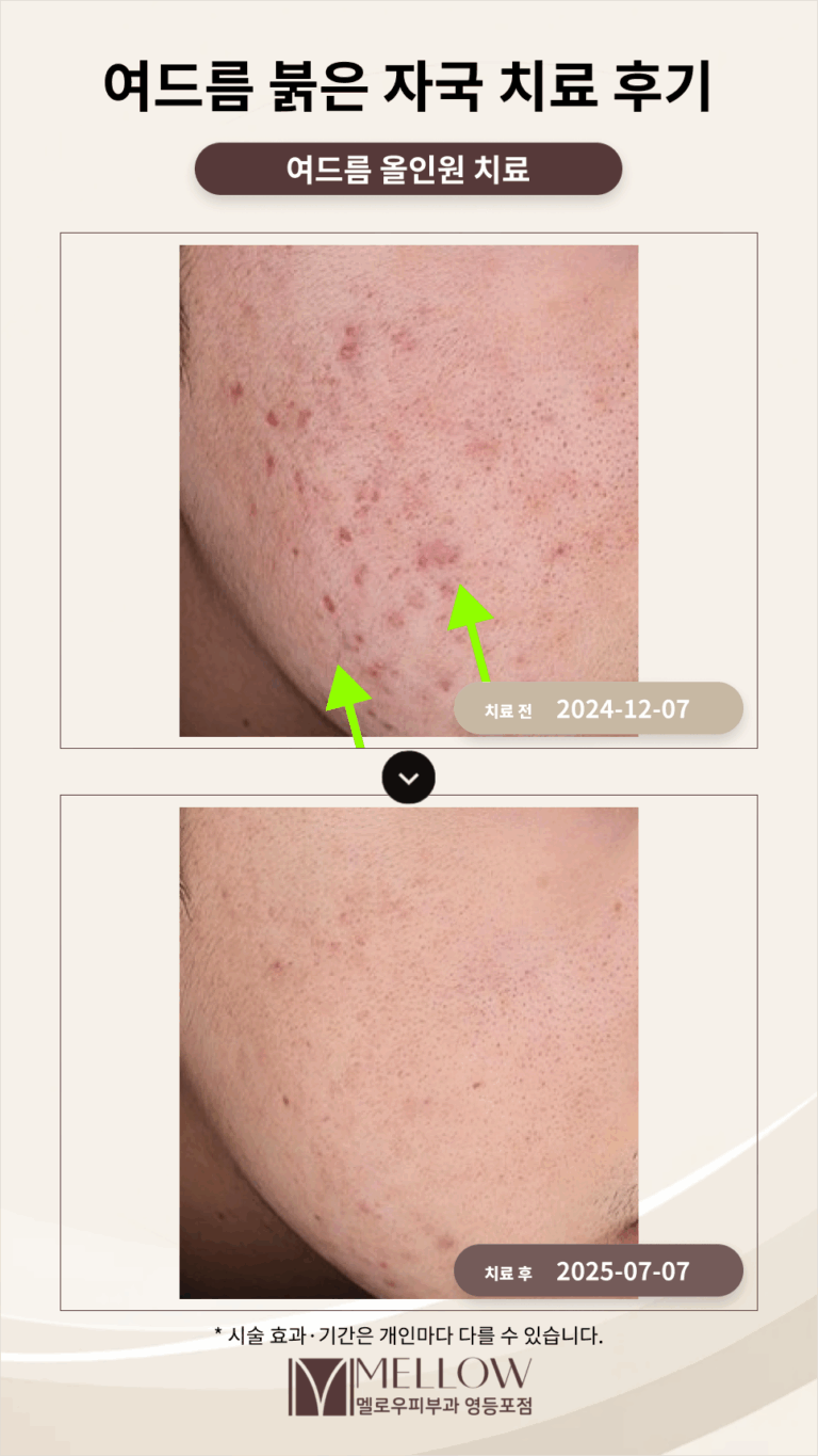 20대 남성 여드름 붉은 자국 치료 후기 _ 여의도피부과전문의