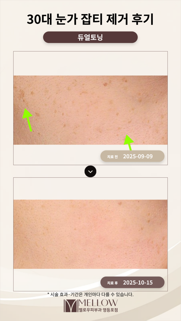 30대 눈가 잡티 제거 후기