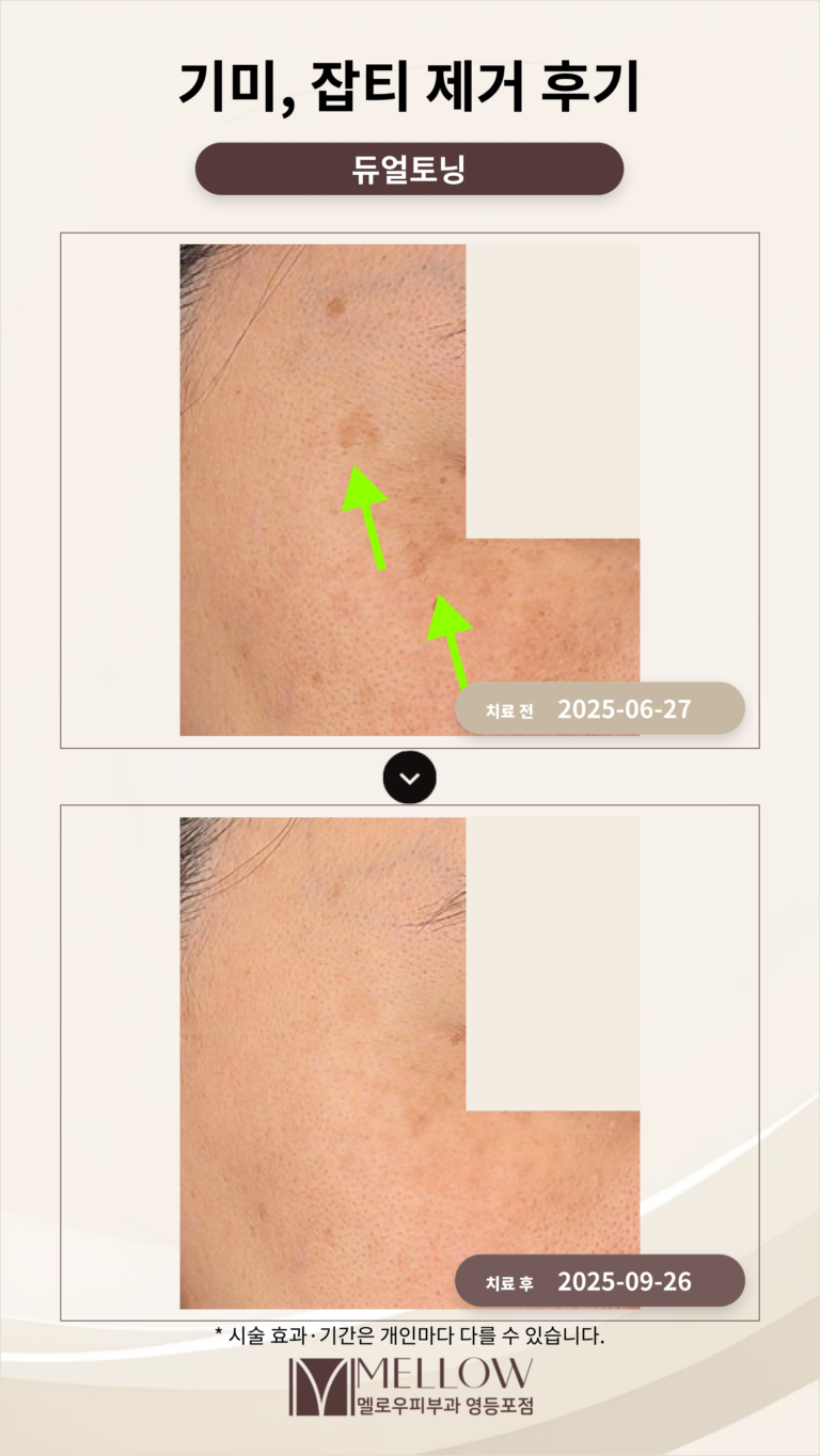 눈가, 관자 부위 기미, 잡티 제거 후기 #레이저토닝
