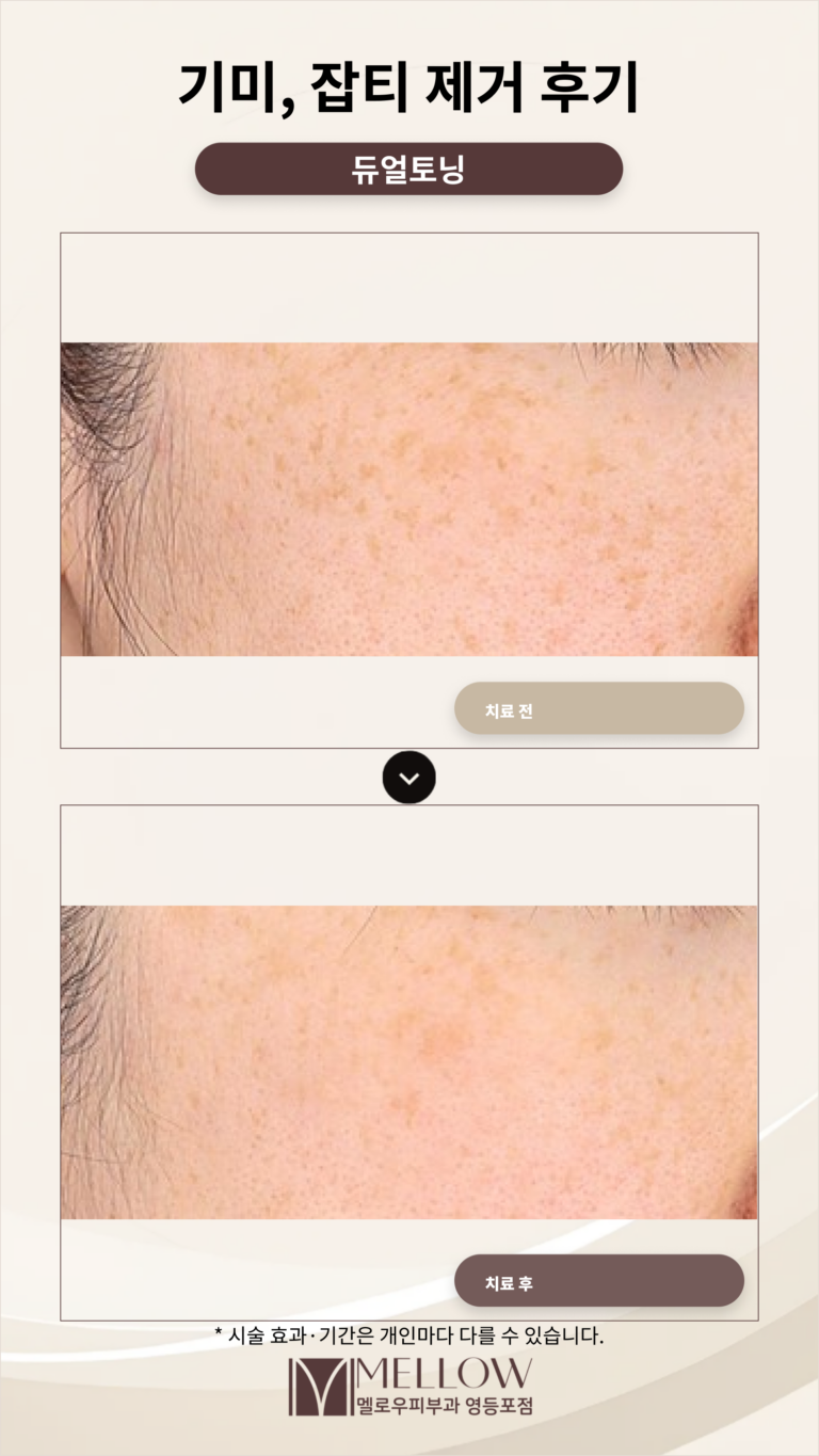 30대 기미, 잡티 제거 후기 #듀얼토닝 후기