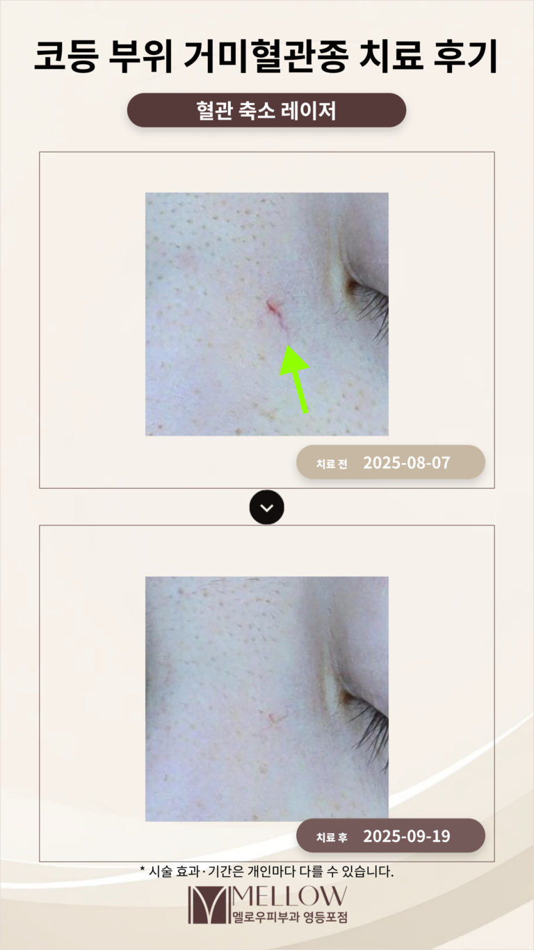 30대 코등 부위 붉은 자국, 거미혈관종 치료 후기