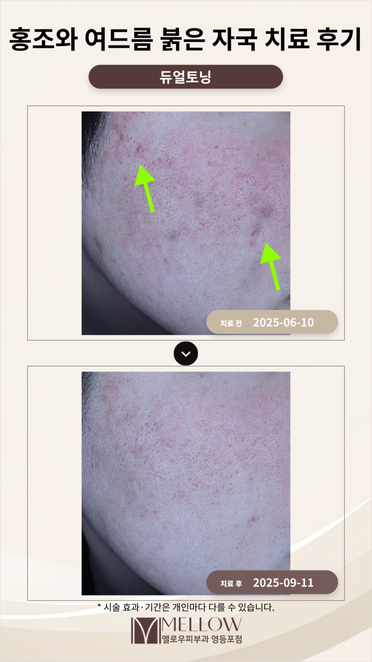 30대 남성 홍조와 여드름 붉은 자국 차료 후기 #레이저치료