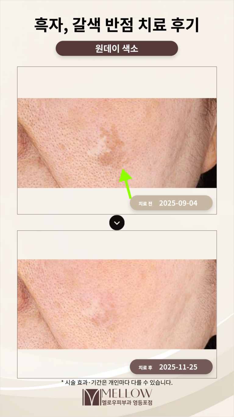 60대 흑자, 갈색 반점 원데이 색소 치료로 완화된 후기