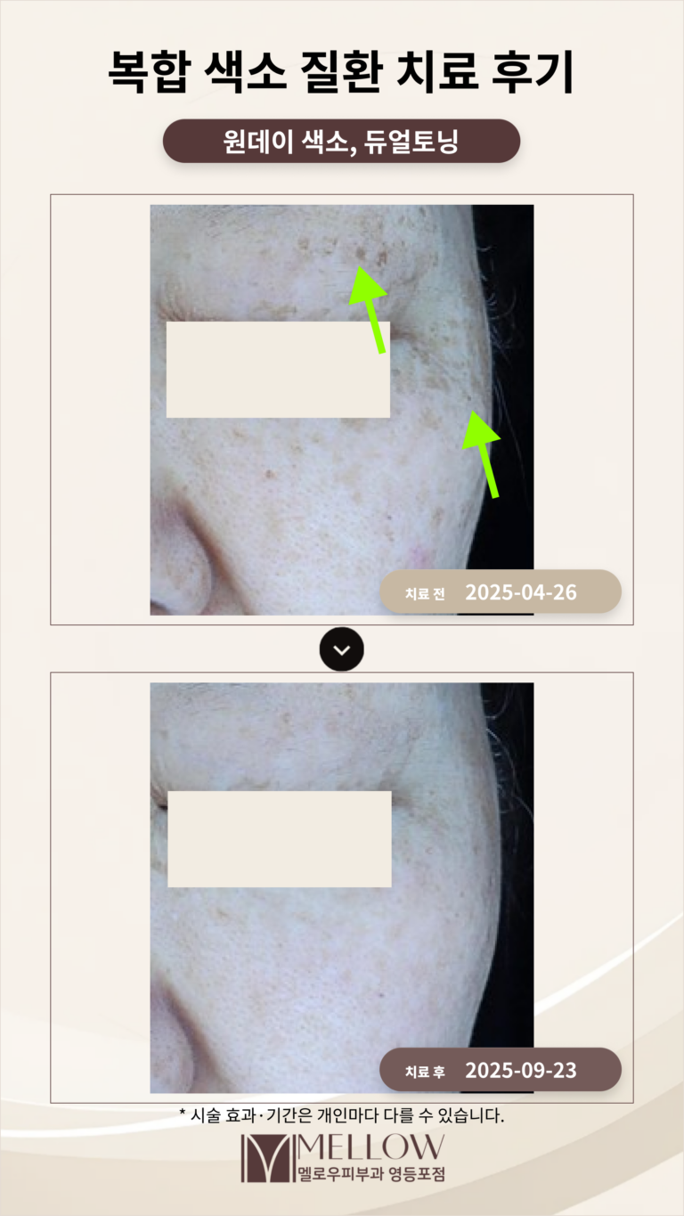 60대 기미, 잡티, 흑자 복합 색소 질환 치료 후기 #색소 레이저 치료효과