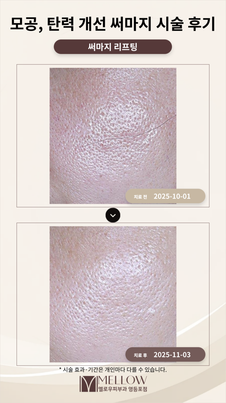 50대 여성 모공, 탄력 개선을 위한 써마지 시술 후기