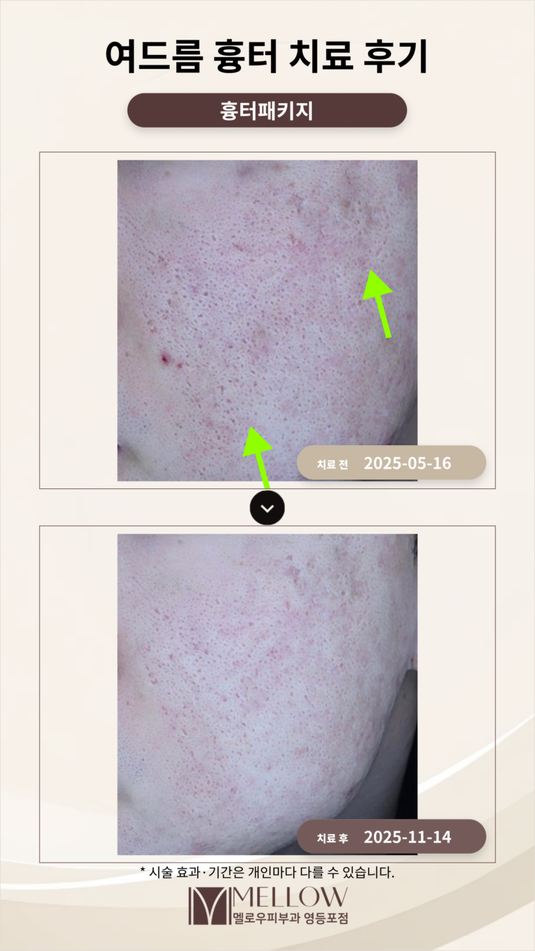 30대 여드름 흉터 치료 후기 #흉터 치료 방법